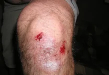 How to Immediately Treat a Knee Injury Knee Injury