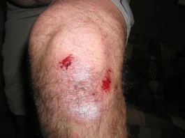 Knee Injury