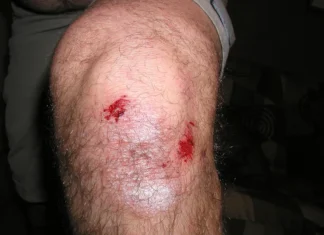 How to Immediately Treat a Knee Injury Knee Injury