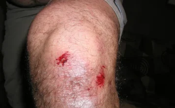 How to Immediately Treat a Knee Injury Knee Injury