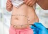 Liposuction vs. Tummy Tuck Surgery in Abu Dhabi: Which Is Right for You? Tummy Tuck Surgery