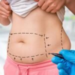 Liposuction vs. Tummy Tuck Surgery in Abu Dhabi: Which Is Right for You? Tummy Tuck Surgery