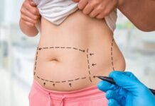 Liposuction vs. Tummy Tuck Surgery in Abu Dhabi: Which Is Right for You? Tummy Tuck Surgery