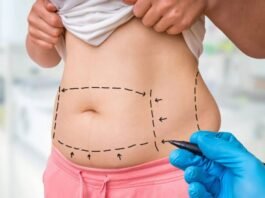 Tummy Tuck Surgery