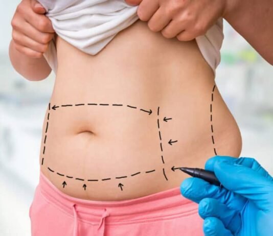 Liposuction vs. Tummy Tuck Surgery in Abu Dhabi: Which Is Right for You? Tummy Tuck Surgery