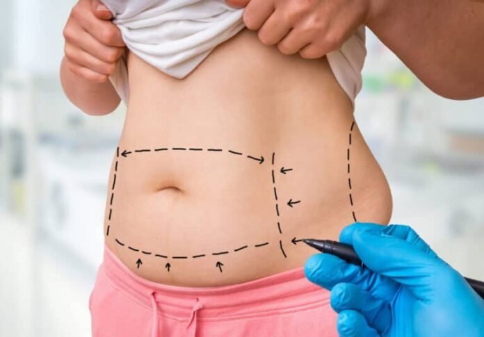 Tummy Tuck Surgery