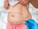 Liposuction vs. Tummy Tuck Surgery in Abu Dhabi: Which Is Right for You? Tummy Tuck Surgery