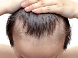 Balding and Receding Hairlines 