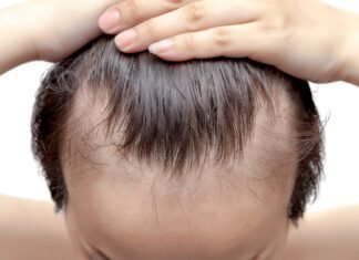Reclaiming the Frame: Treatments for Balding and Receding Hairlines Balding and Receding Hairlines