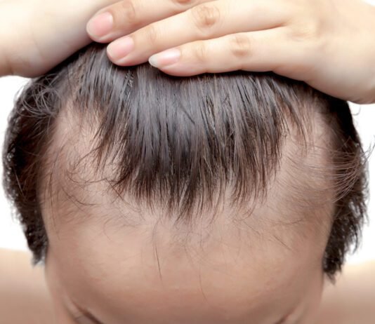 Reclaiming the Frame: Treatments for Balding and Receding Hairlines Balding and Receding Hairlines