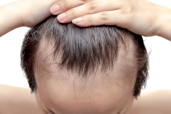 Treatments for Balding and Receding Hairlines Balding and Receding Hairlines