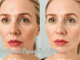 Bad Botox Before and After: Detailed Analysis of Cosmetic Injection Mistakes, Facial Damage, and Recovery Options Bad Botox Before And After